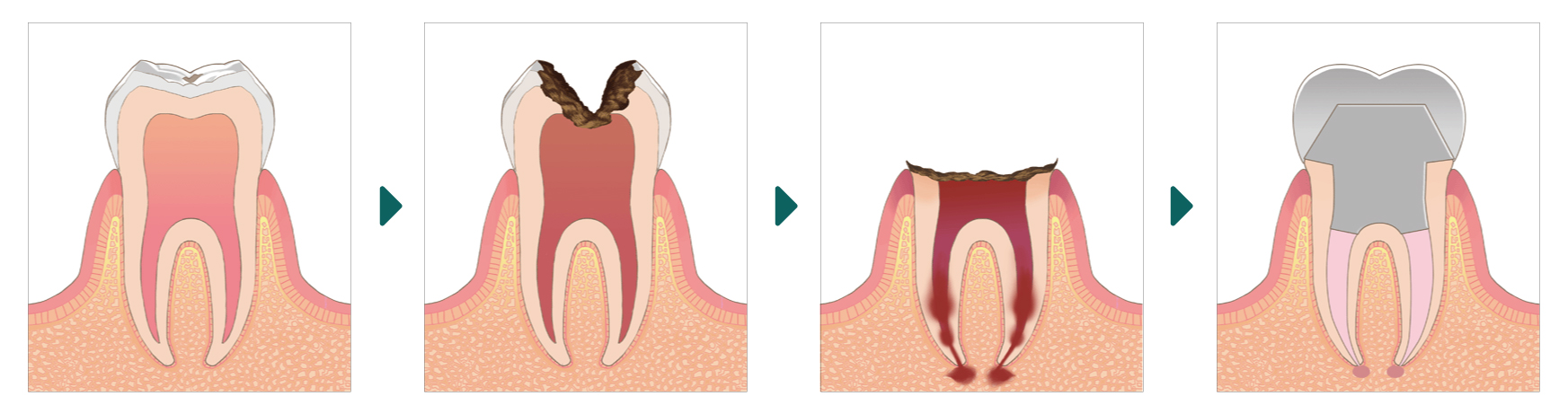 虫歯の進行