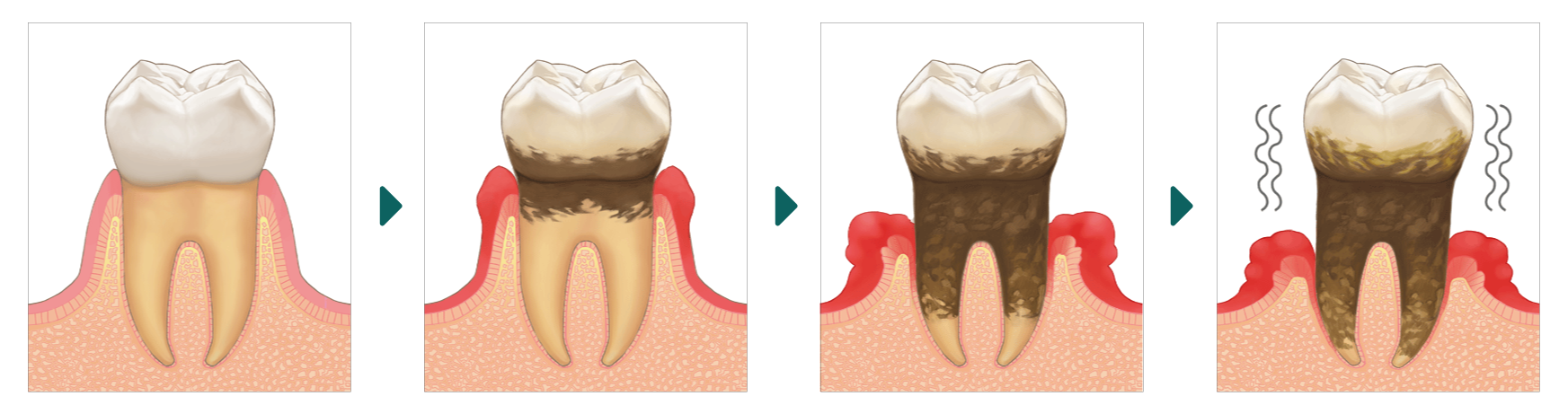 歯周病の進行